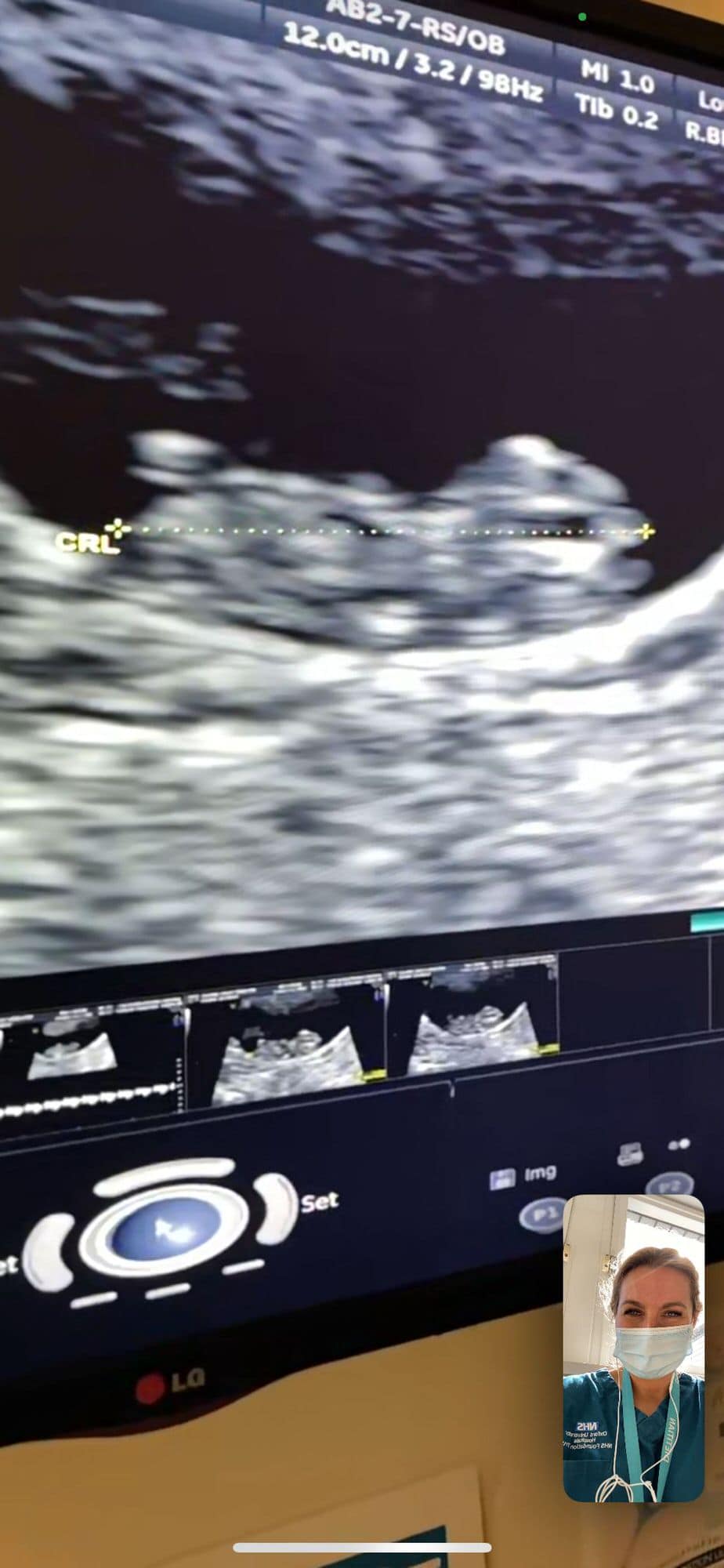 Facetime ultrasound scan